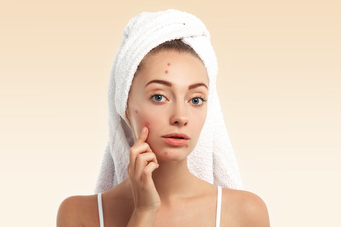 Acne And Pimple Products In Pakistan