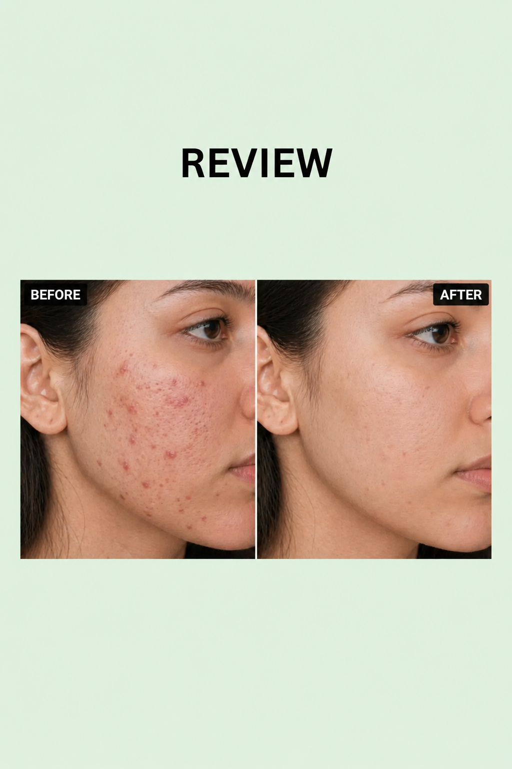 Acne free skin bundle