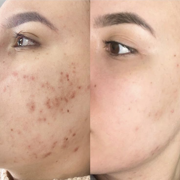 KLEAN | ACNE CONTROL CREAM