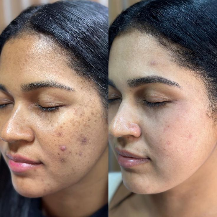 Marifer | Skin whitening cream