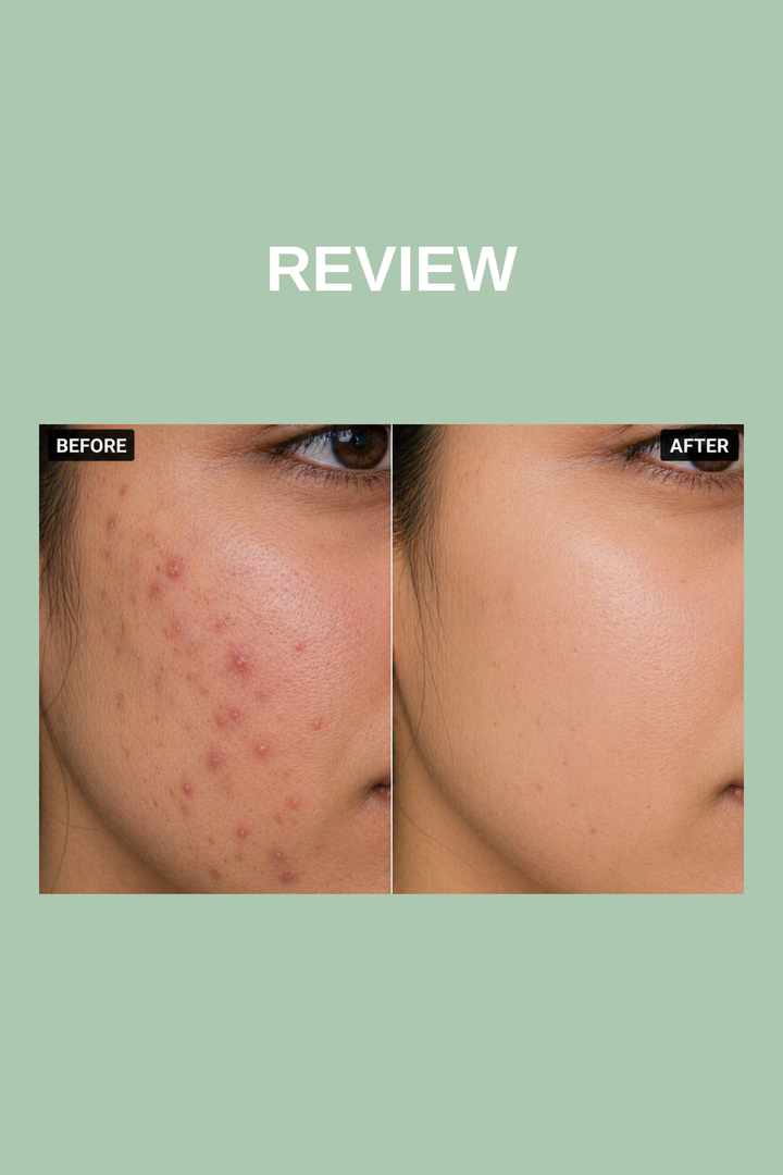 ACKLER | ACNE DEFENSE FACEWASH