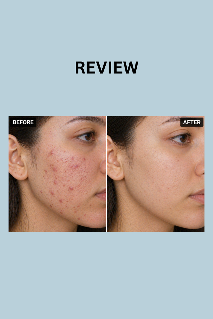 ACFER ANTI-ACNE SERUM