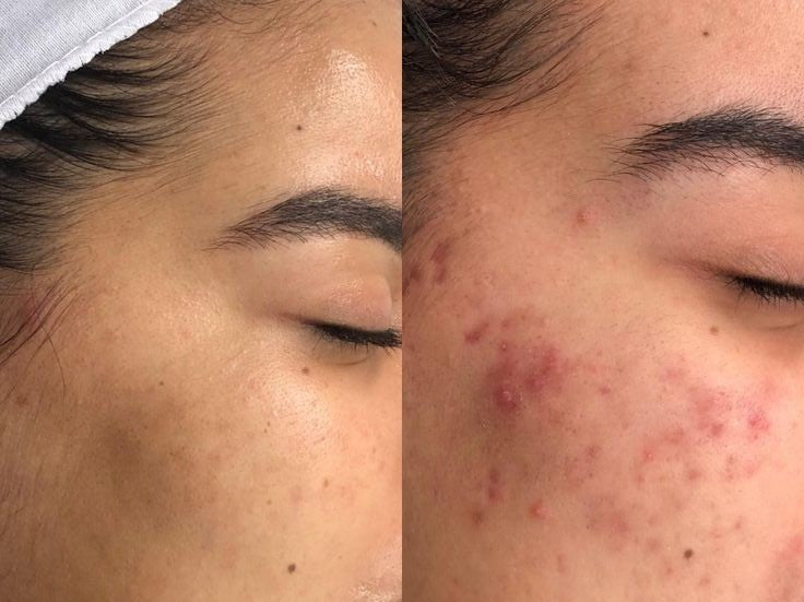 ACFER ANTI-ACNE SERUM